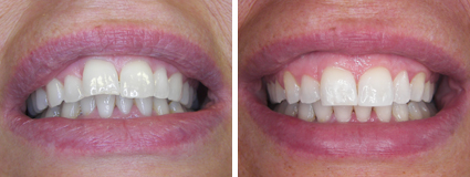 Six Month Smiles Case Study 4