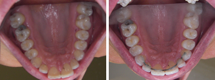 Six Month Smiles Case Study 5