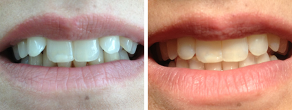 invisalign Case Study 4