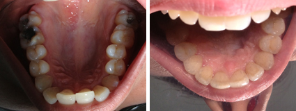 invisalign Case Study 5