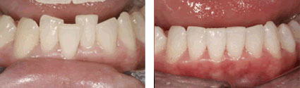 Inman Aligner Case Study 1