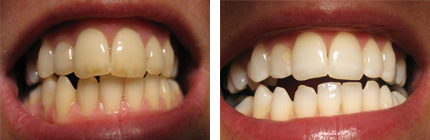 Six Month Smiles Case Study 1